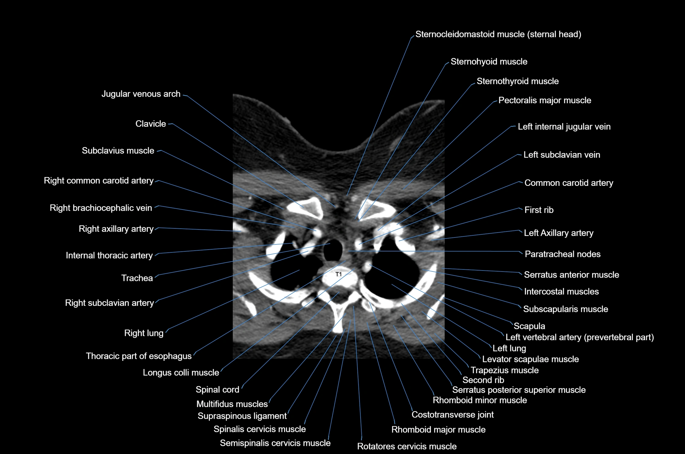 CT Neck axial cross sectional anatomy radiology image-img-00001-00057.webp